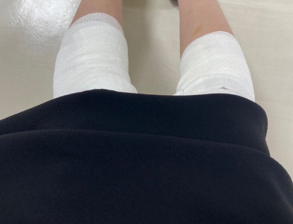 火傷の受診後に包帯を巻かれている膝